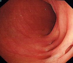 正常的大腸內(nèi)壁