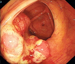 大腸內(nèi)壁的腫瘤